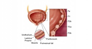 Bladder Cancer