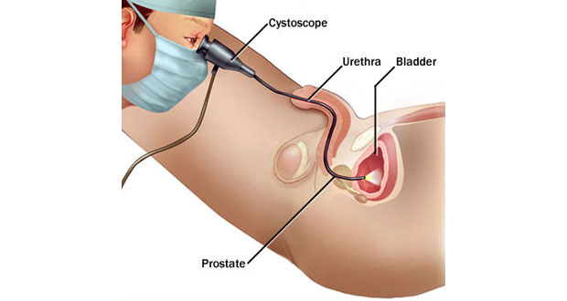 Flexible Cystoscopy & Urodynamics Study