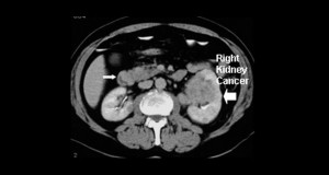 Kidney Cancer