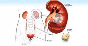 Kidney Stone Causes