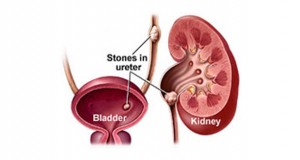 Kidney Stone