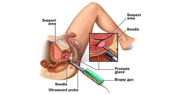 Prostate Biopsy