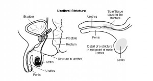 Urethral Stricture