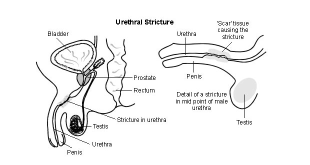 Urethral Stricture