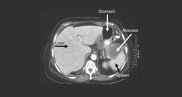 Urinary Tract Infection