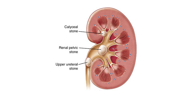 You Can Prevent Kidney Stones with Lifestyle Changes