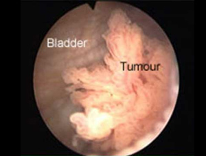 bladder_cancer2