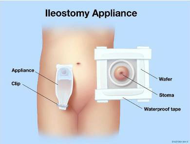 ileostomy-appliance-sm